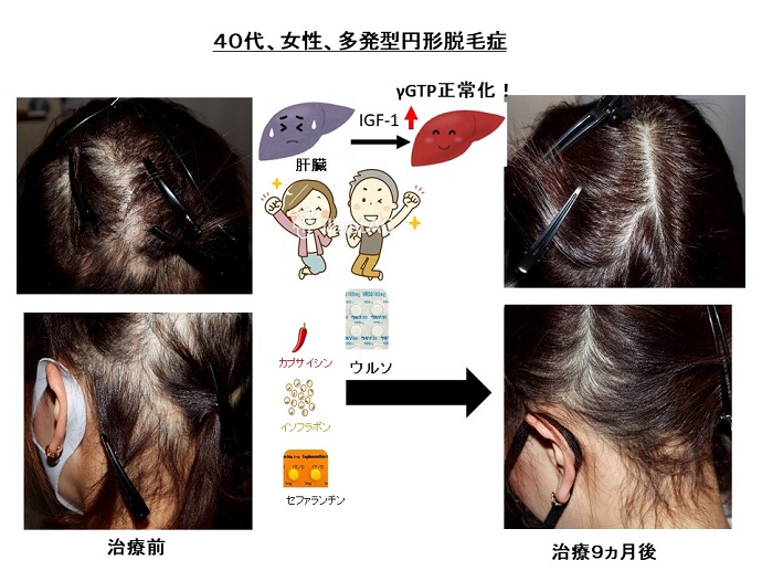 円形脱毛症　病院